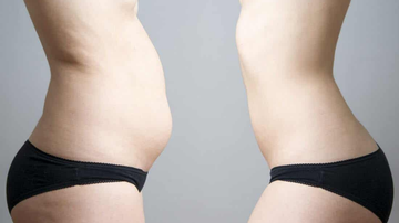 A diástase abdominal é a principal causa de flacidez abdominal - Reprodução: Pinterest