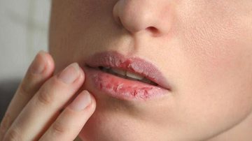Imagem Estresse de quarentena: por que você precisa parar agora de morder ou lamber os lábios