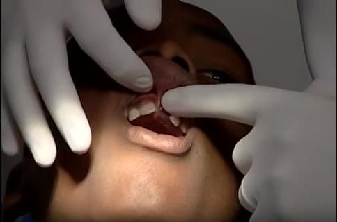 Imagem Trauma dentário: o que fazer quando o dente quebra ou cai?