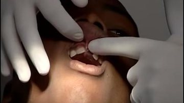 Imagem Trauma dentário: o que fazer quando o dente quebra ou cai?