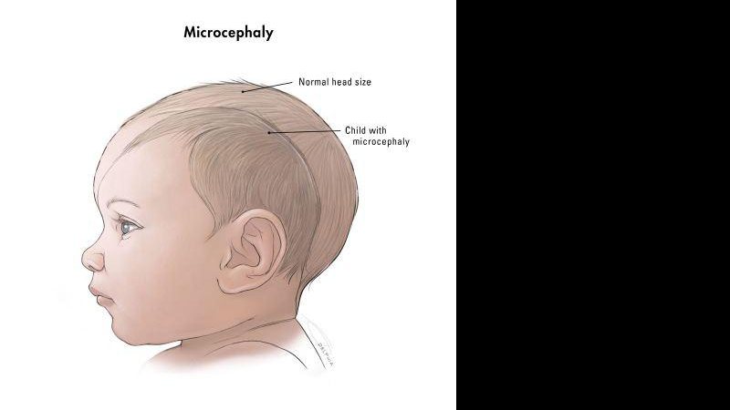 Imagem Entenda o que é a microcefalia e porque há um aumento dos casos em Pernambuco