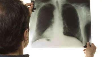 Imagem OMS quer acabar com a epidemia da tuberculose até 2035
