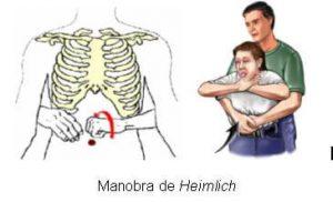 manobra-de-heimlich