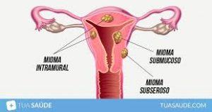 Representação de útero com localização de miomas