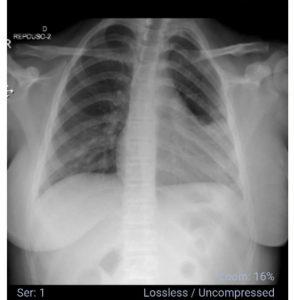 Radiometria do pulmão de Beatriz