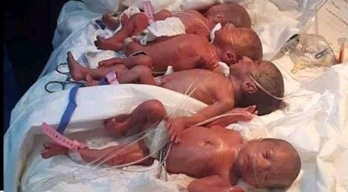 Nascimento de nove bebês em um caso raríssimo de nônuplos